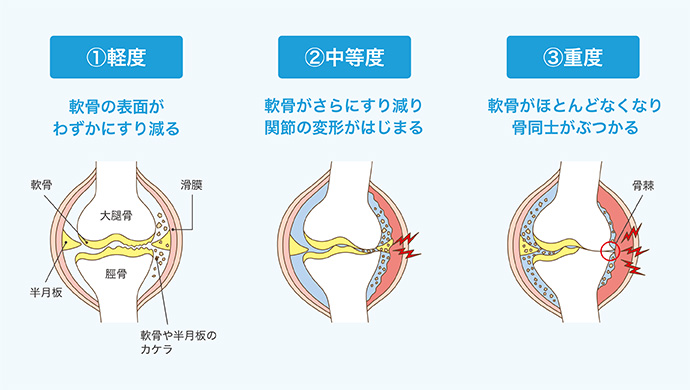 知っておきたい！ 変形性ひざ関節症の進行度と症状