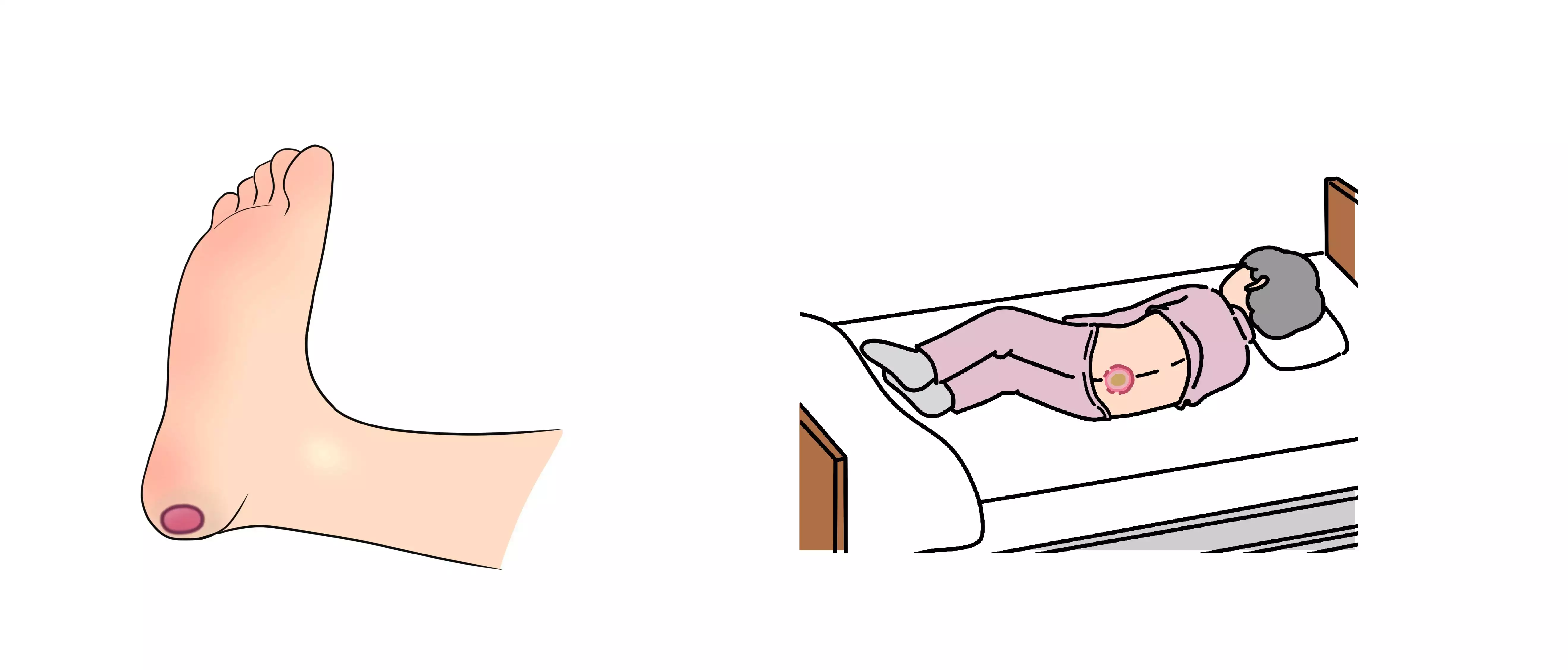 MySCUE記事　褥瘡ケア　褥瘡のできやすい箇所