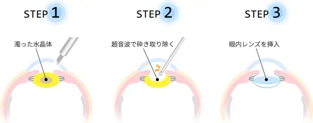 水晶体手術のプロセス